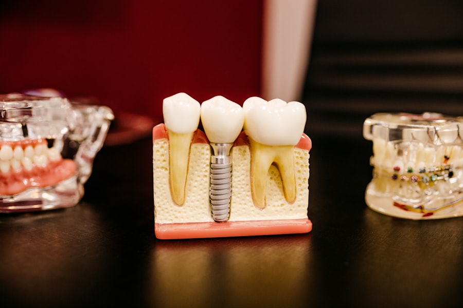 Implantes dentales en La Plata
